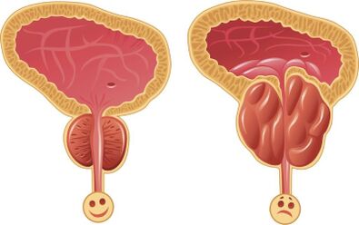 Prostate masculine saine et enflammée