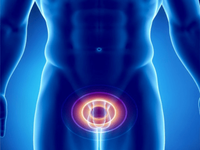 Prostatite, inflammation de la prostate chez un homme.