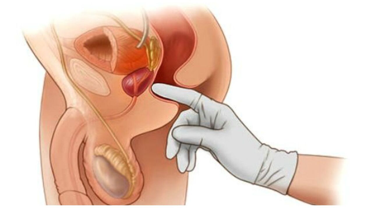 massage de la prostate