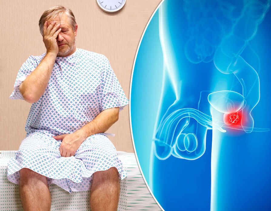 Un homme atteint de prostatite reçoit un diagnostic de maladie. 