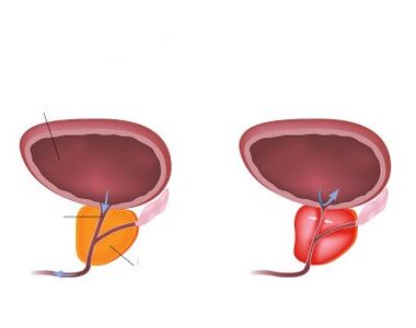 Prostate normal et enflammé