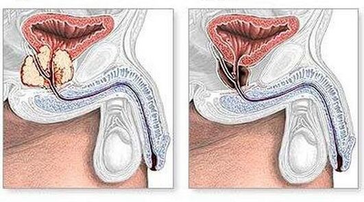 Avant et après le traitement chirurgical de la prostatite chronique. 